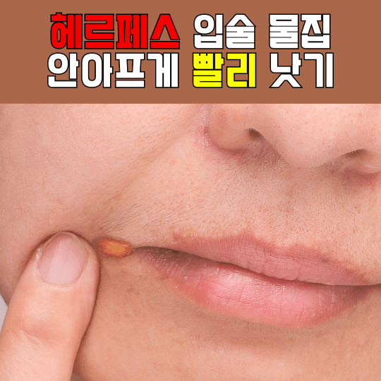 헤르페스 입술 물집 빨리 낫기