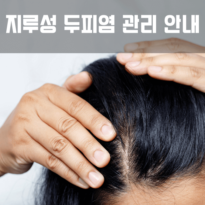 두피 건강을 위한 효과적인 지루성 두피염 관리 안내