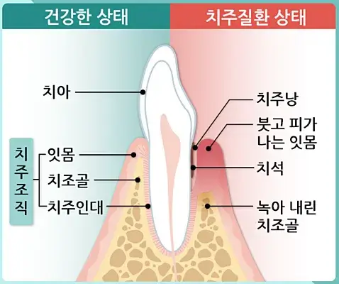 잇몸 건강, 왜 꾸준한 관리가 필수인가?