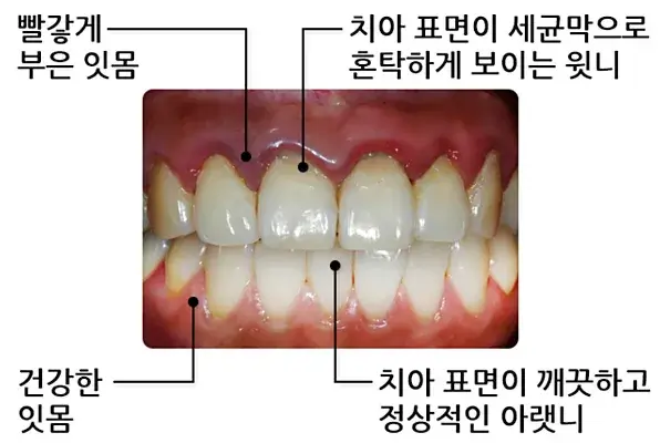 잇몸 건강, 왜 꾸준한 관리가 필수인가?