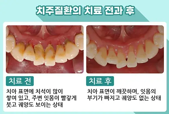 잇몸 건강, 왜 꾸준한 관리가 필수인가?